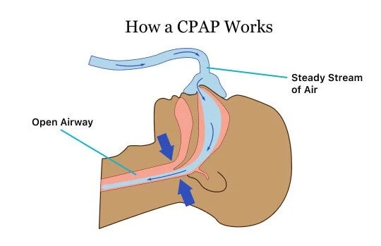 Diagram showing how a CPAP machine works by delivering a steady stream of air through the nose to keep the airway open during sleep.