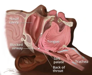 Medical illustration showing airway blockage during sleep, highlighting the nasal cavity, tongue, soft palate, trachea, and blocked airway at the back of the throat.